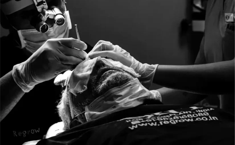 hair transplantation process going on